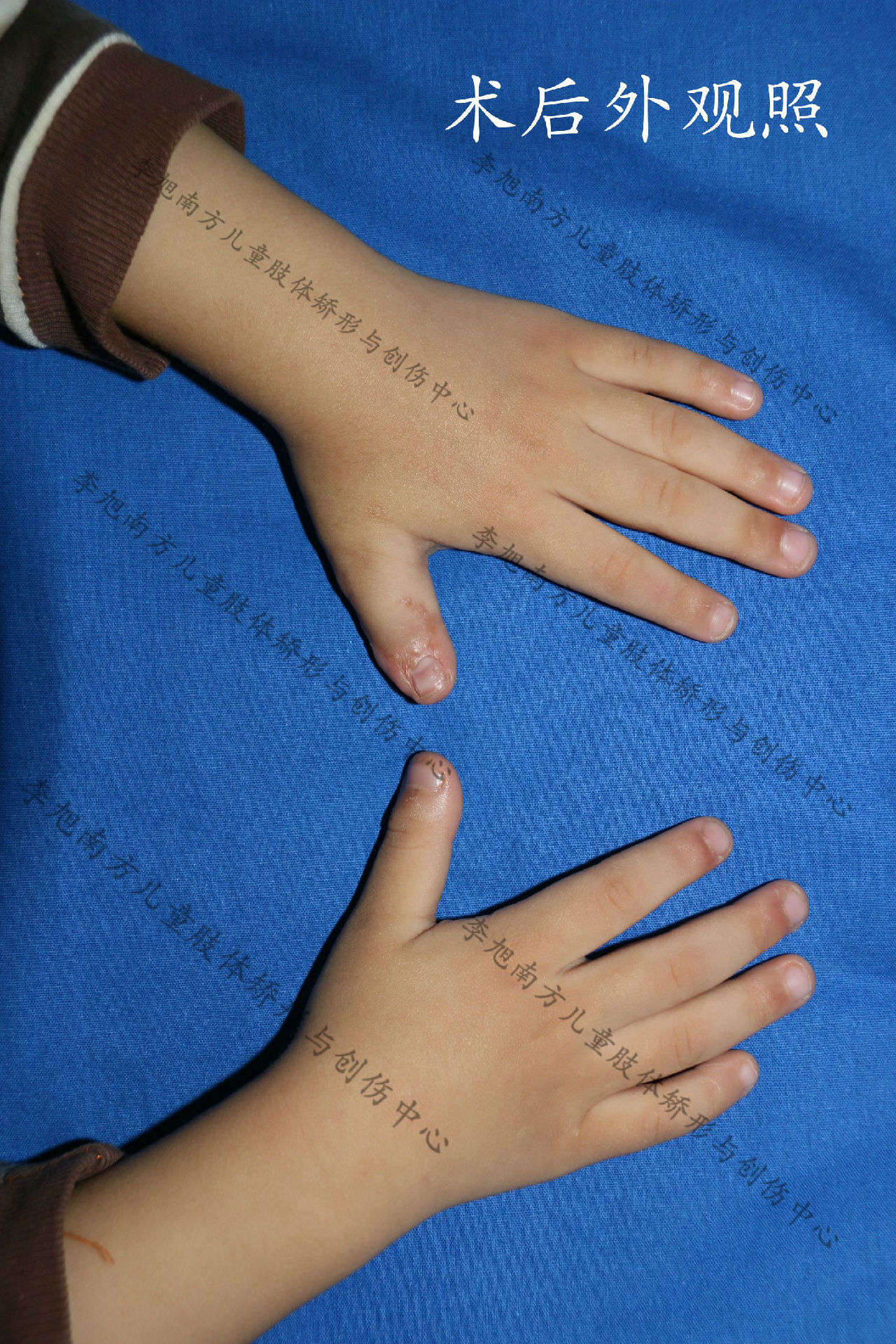 多指就真的是"多子多福"吗?_李旭医生文章_南方医科大学第三附属医院-