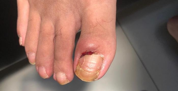 慢性甲沟炎的正确处理