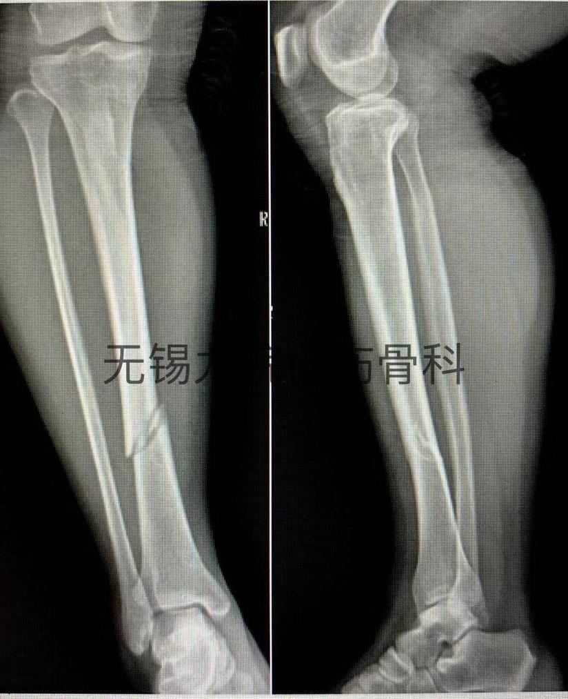 Mipo技术微创治疗胫骨中下段骨折 健康号 微医
