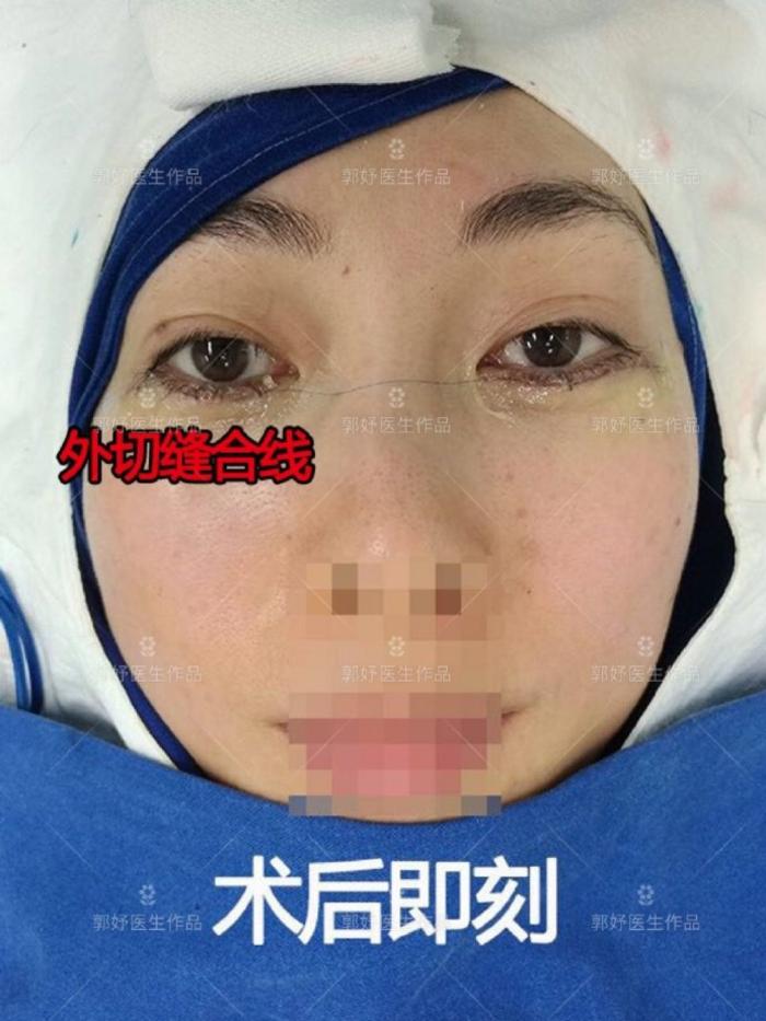 案例外切眼袋术后2周