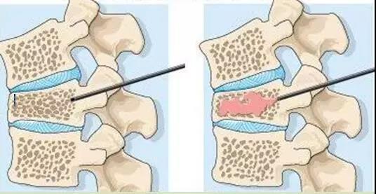 胸腰椎压缩骨折怎么办微创骨水泥注射椎体成型是好办法
