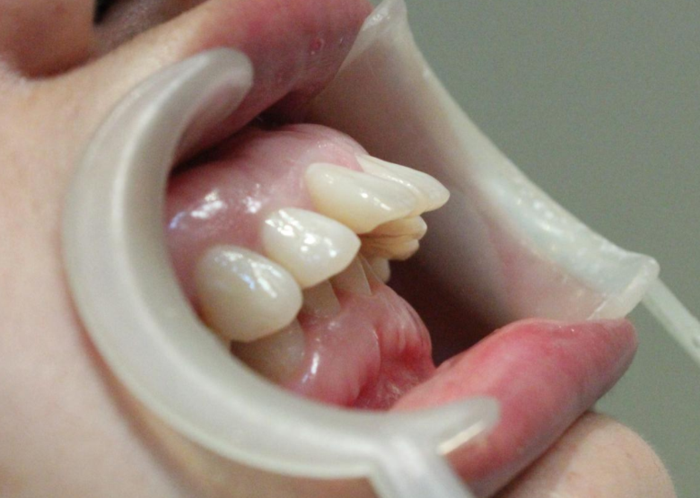 导致龅牙前突的原因有哪些