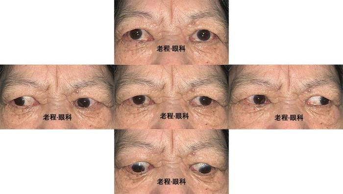 骨性眼眶减压手术,可以解除眶尖拥挤综合征,中止并逆转视神经病变.