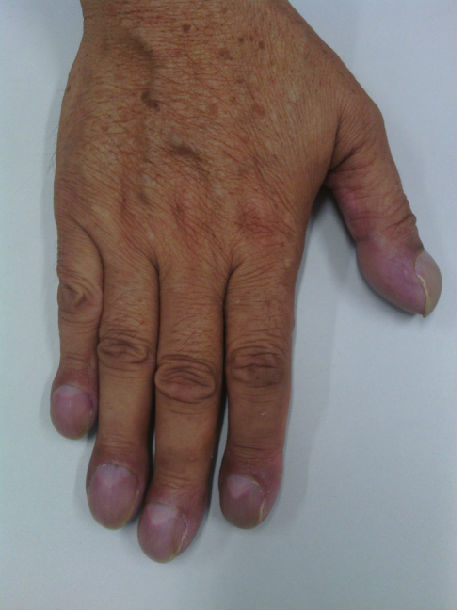 图7:杵状指图8:咳嗽图9:呼吸困难