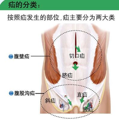 为什么会得疝气 最佳疝气手术方式,专科为您私人定制!