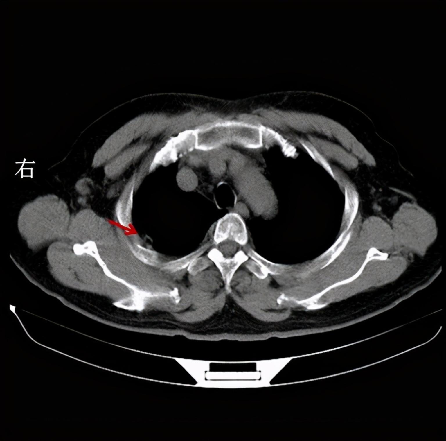 局限性胸膜增厚,这种情况在临床上非常常见,我们在阅胸片或ct的时候