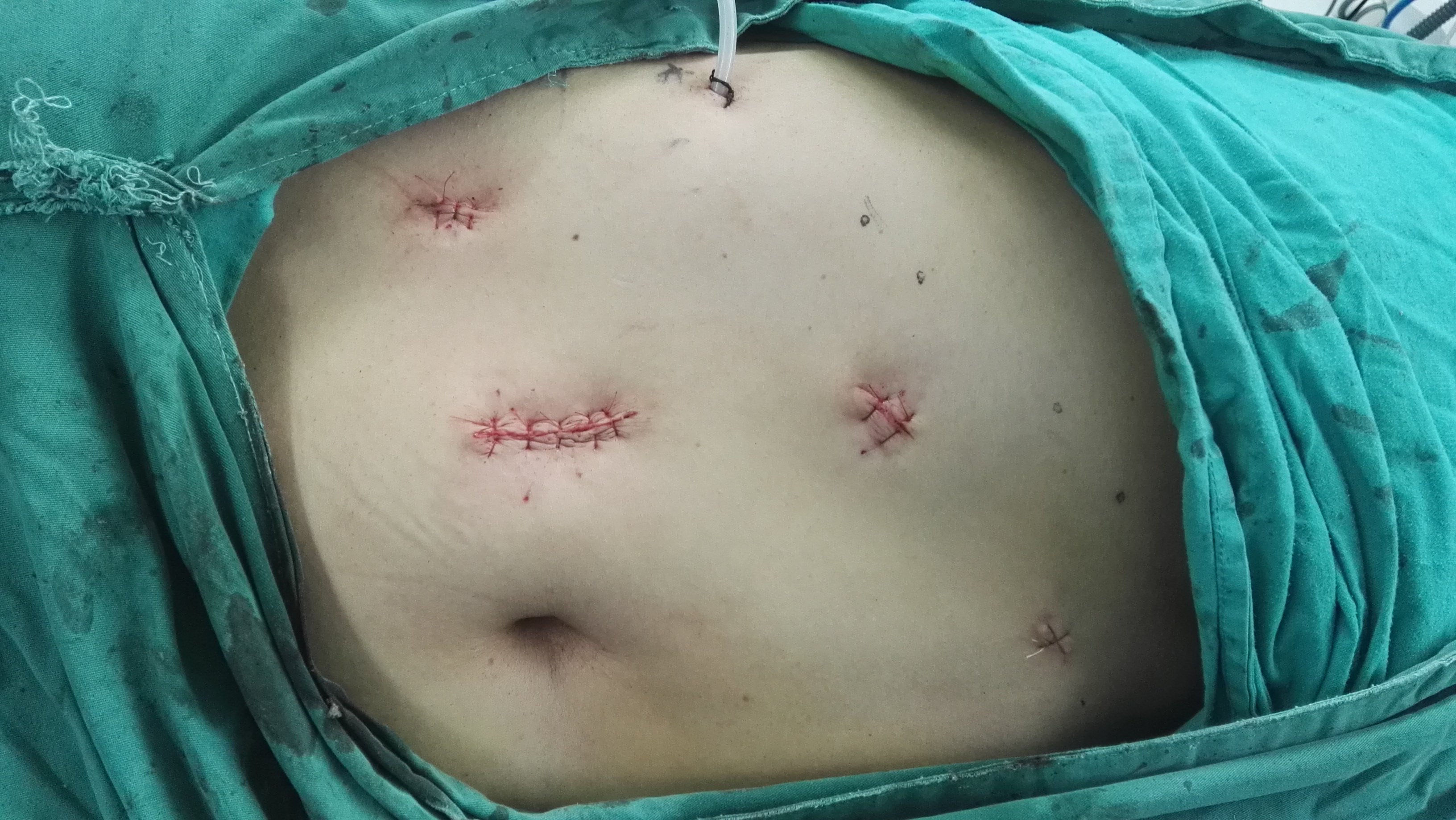 手术切口,5个穿刺孔,因此,患者痛苦小,恢复快!