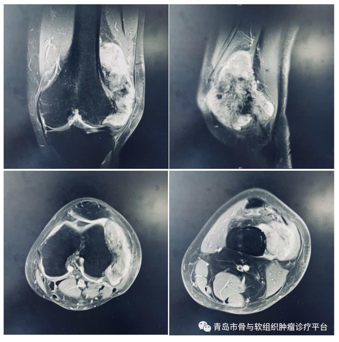 【典型病例】膝关节原发恶性骨肿瘤一期手术切除肿瘤型膝关节假体置换
