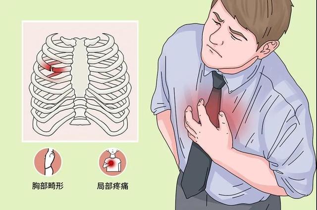 肋软骨炎中医治疗 - 微医(挂号网)