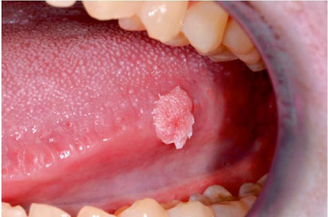 舌侧面可见菜花状新生物从以上图片可以看出:口腔尖锐湿疣皮疹隆起呈