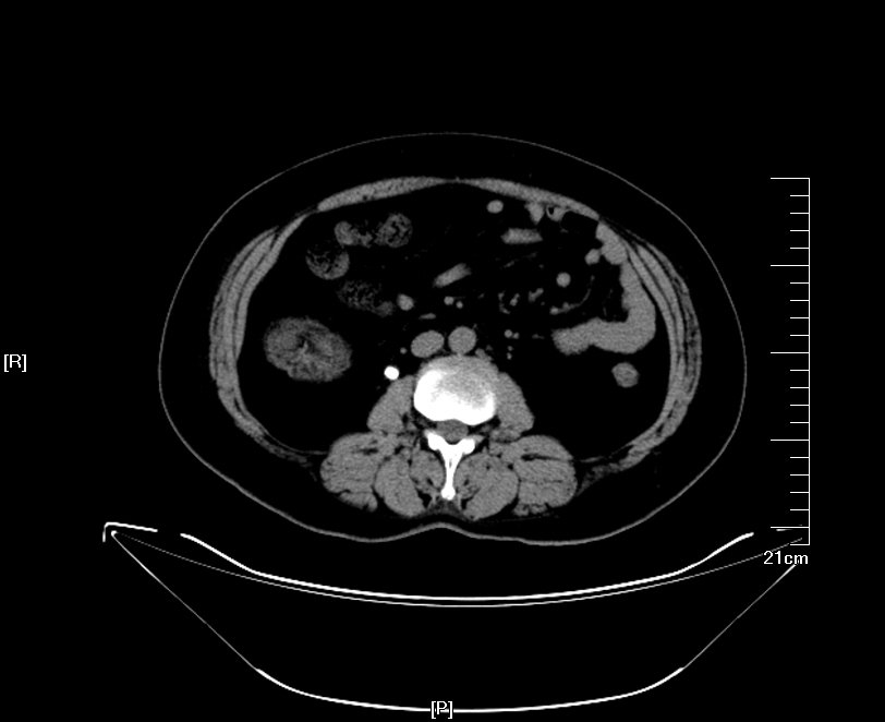 输尿管镜下钬激光碎石术的注意事项