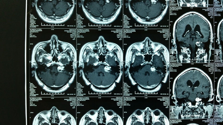 贺晓生听神经瘤切除术与术中面神经保护复查