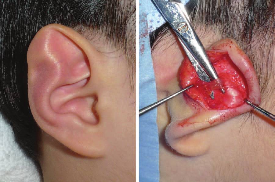 从耳周肌肉分布图解释杯状耳招风耳隐耳畸形如何修复