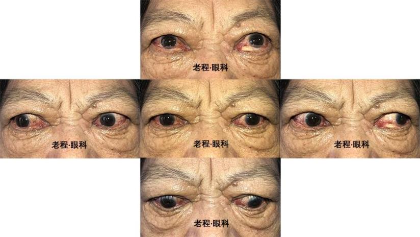 甲亢突眼之挽救视力性眼眶减压手术 健康号 微医