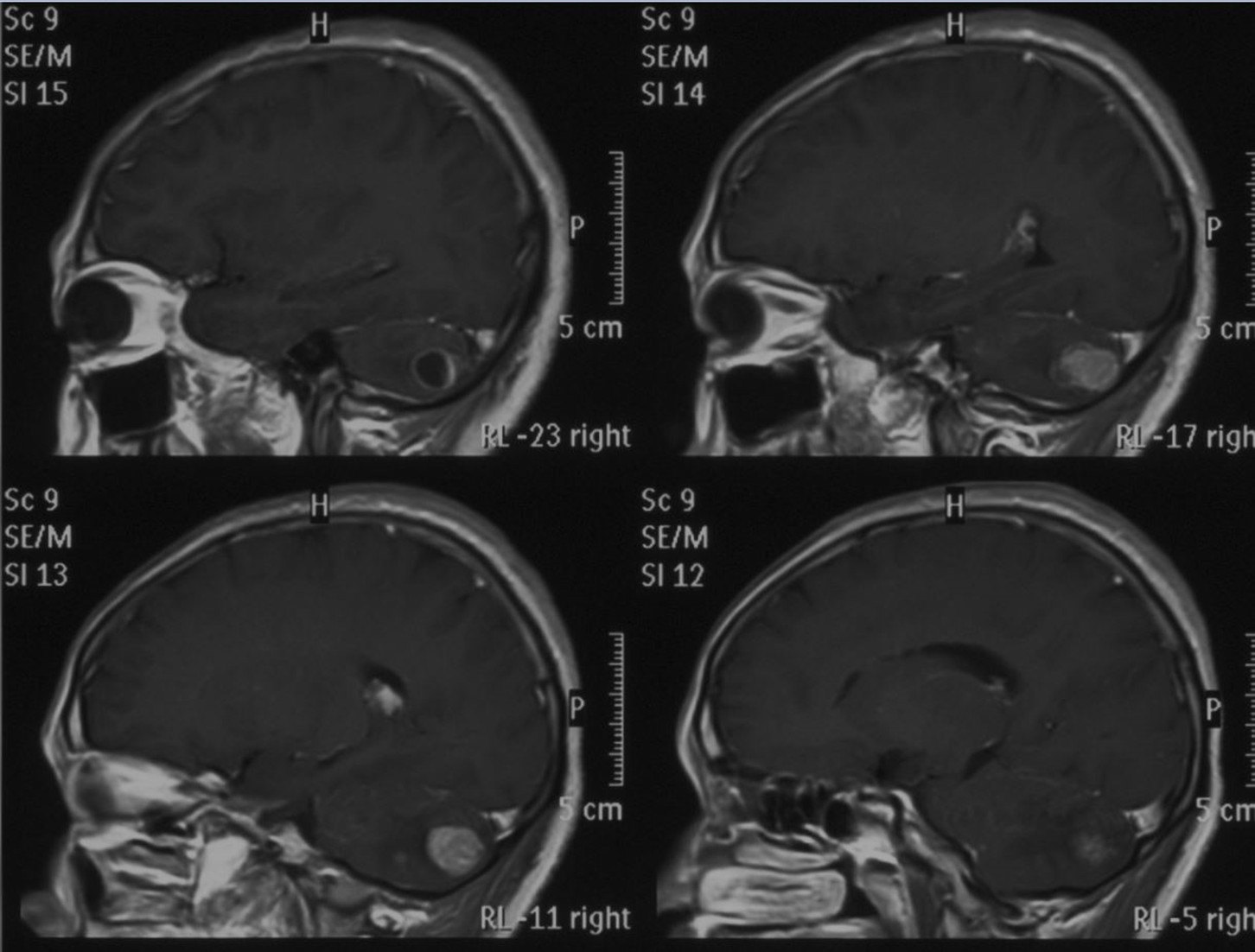手术治疗小脑转移瘤一例 - 微医(挂号网)