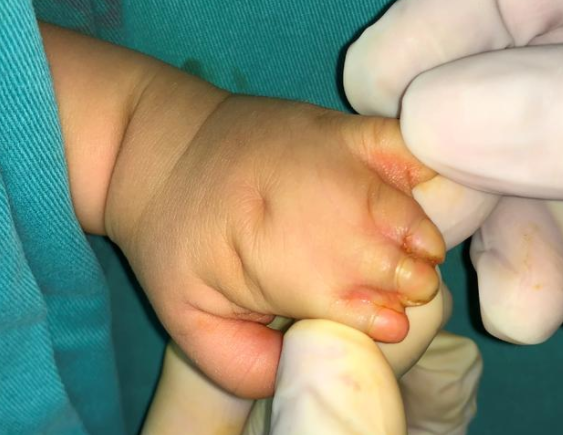 波兰综合征短指并指一是要尽早手术二是术后要尽早开始功能锻炼