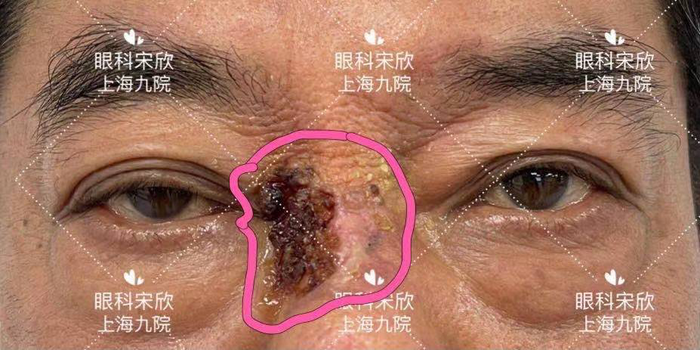 眼睑恶性肿瘤的第三号"杀手"——鳞状细胞癌 - 微医(挂号网)