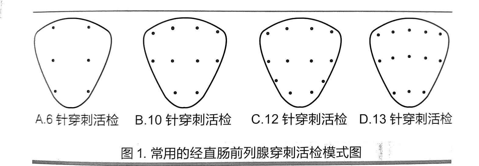 前列腺穿刺12点示意图图片