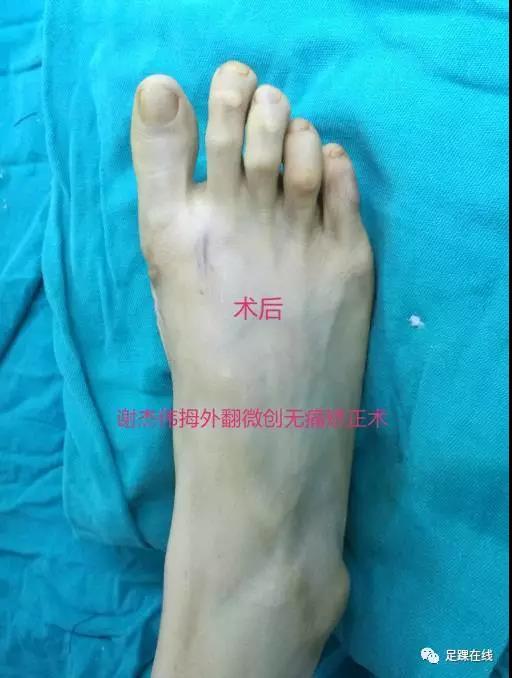 拇外翻俗称大脚骨的微创无痛美容矫正术