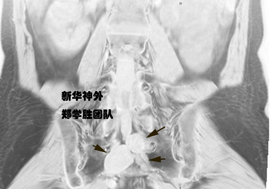 坐骨结节囊肿手术图解图片