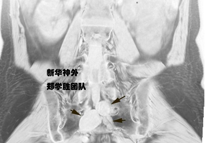 多发巨大骶管囊肿微创手术一例