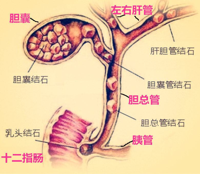 什么是肝胆结石?见上图即知!