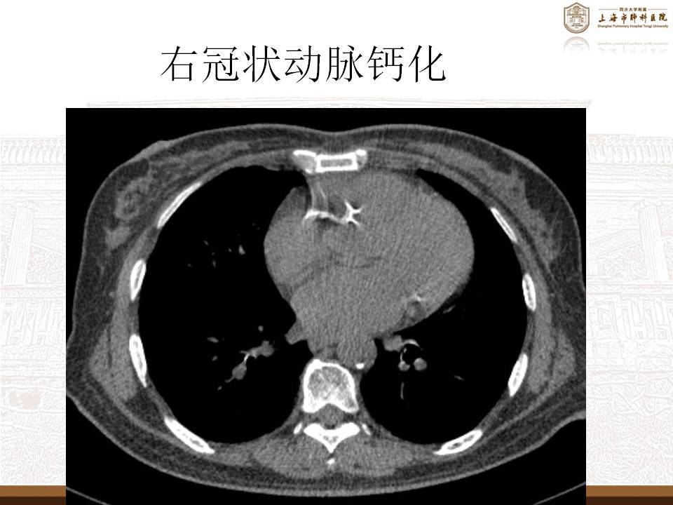 图片描述图片描述图片描述ct片子里的冠脉钙化是指ct里沿冠脉走行分布