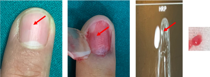 红色箭头所示;图3 mri可见甲床下高信号;图4 切除的血管球瘤