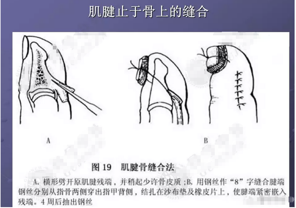 肌腱韧带损伤肌腱缝合的原则和方法汇总