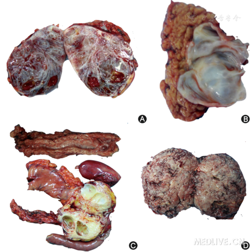 胰腺良性腫瘤