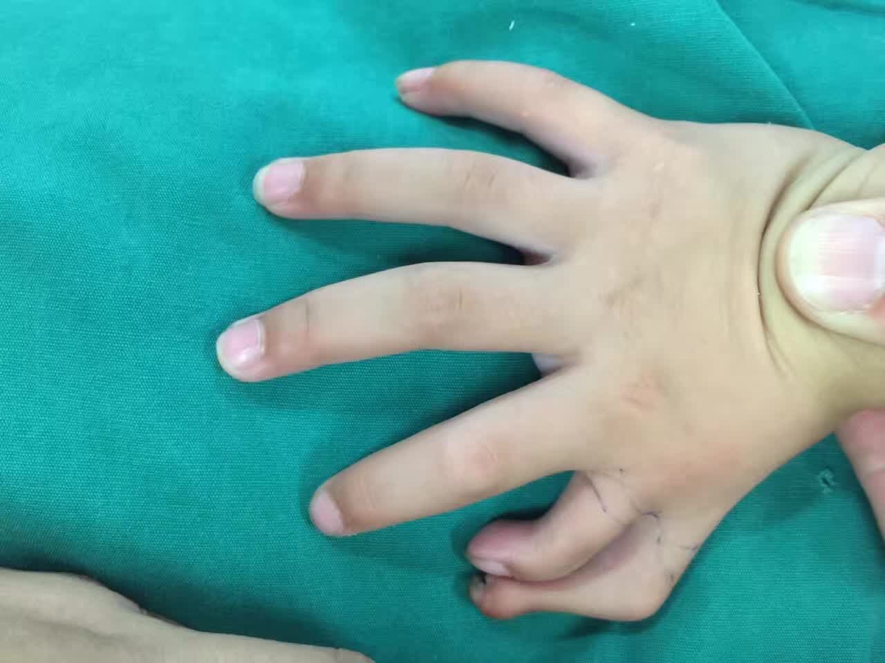 换头术治疗复杂疑难手部先天畸形