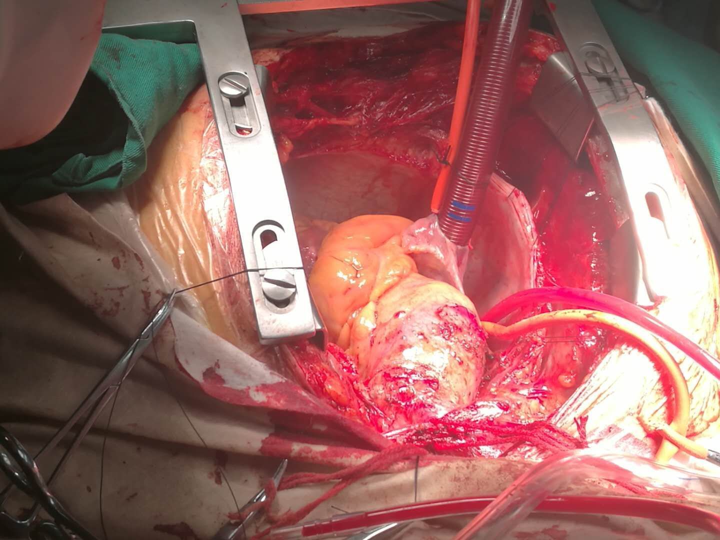 又一主动脉夹层行急诊手术治疗