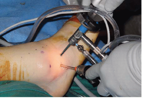 大多数跗骨窦综合症患者可以通过保守治疗缓解症状