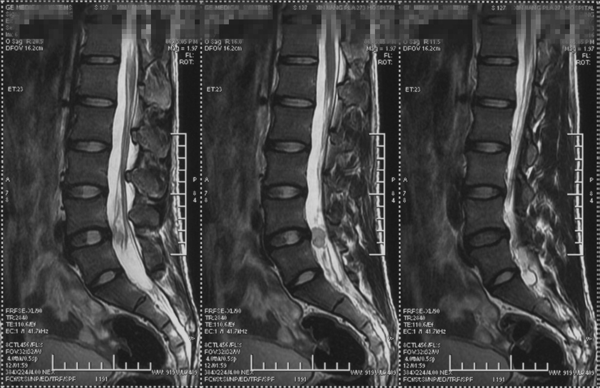 腰椎的核磁共振成像图片....请专家帮我看下_百度知道