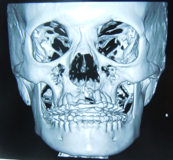 上颌低位水平截骨术lefort1治疗单侧唇裂术后颌骨畸形1