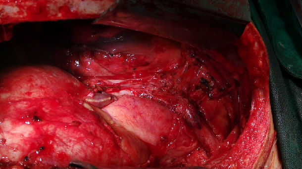 图3.术中肿瘤,整个胸腺,部分心包和血管外膜的切除. 图4.