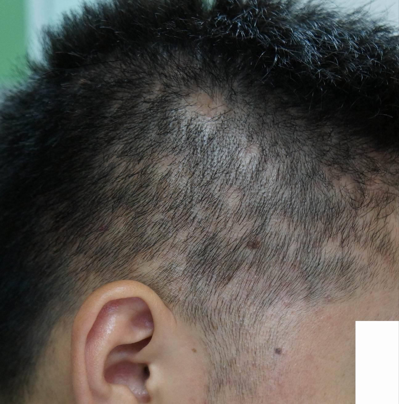 纳尼掉头发也可能是梅毒导致的