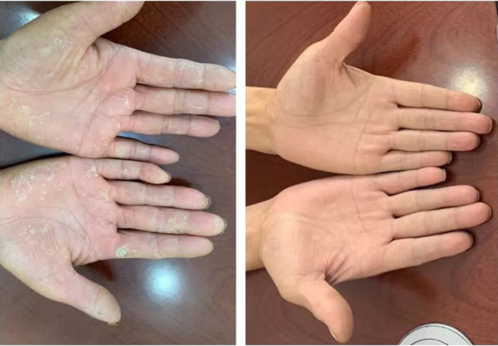 杭州三院皮肤科徐瑾提醒秋季是解决手足癣的好时节