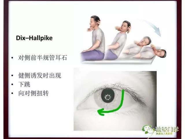 取平卧位,头位抬高30°,向一侧转头90°观察至眩