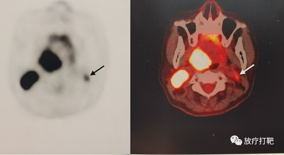 扁桃体癌颈部淋巴结转移不用手术未毁容貌通过放化疗彻底清除