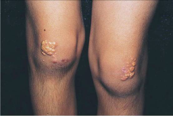 家族性高胆固醇血症黄色瘤