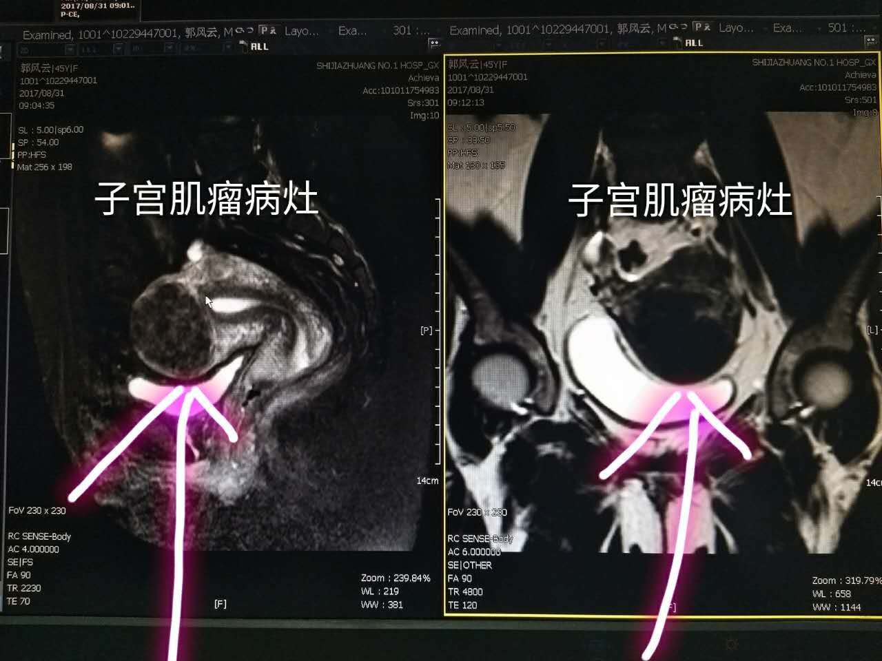 海扶病例分享3例多发性子宫肌瘤的完美海扶消融治疗