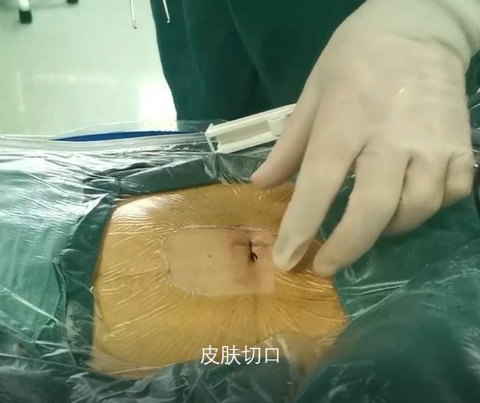 脊柱内镜单侧入路双侧减压endoulbd治疗腰椎管狭窄症