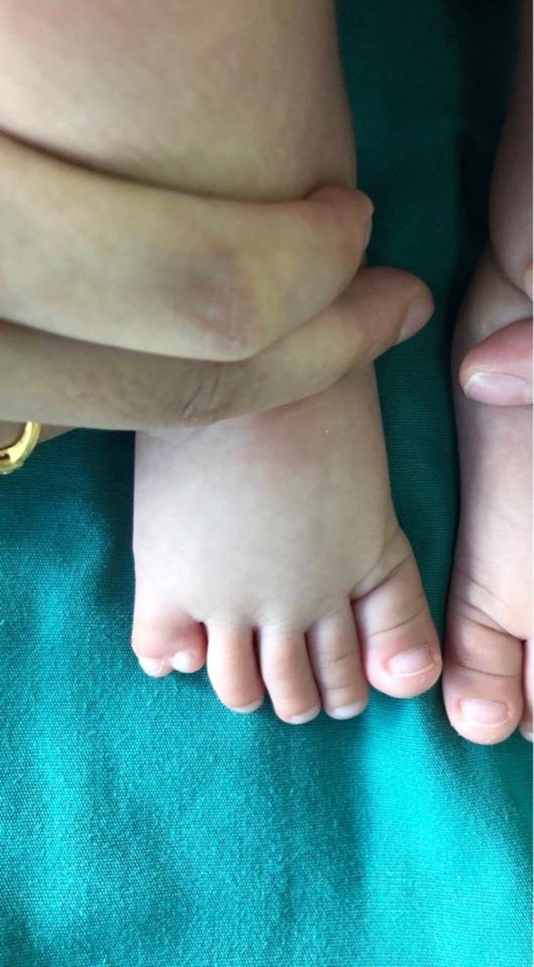 双足小趾多并趾，需要行多趾切除+趾蹼成型，希望还孩子一双美丽的脚 微医（挂号网）