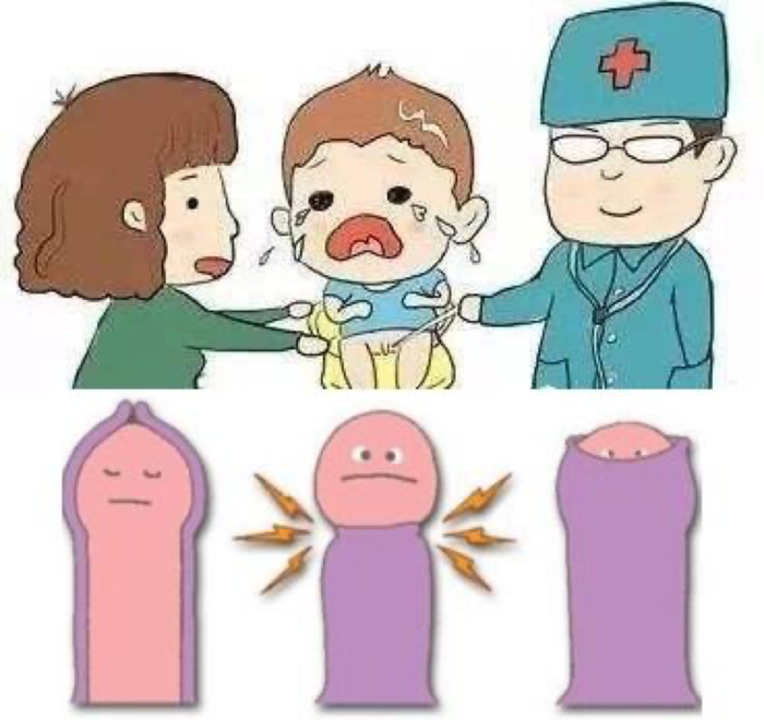 包皮过长隐匿性阴茎做好包皮保卫战