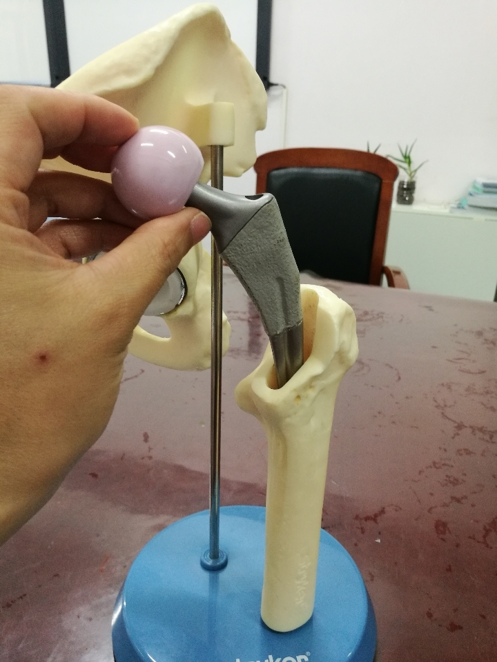 髋关节置换示意图,有需要的可以看看.