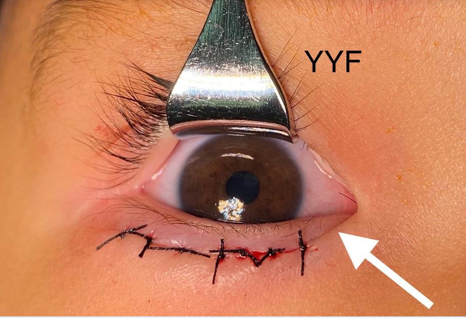 萌宝宝的"大眼"之路----4岁前幼儿的上睑下垂手术—额肌悬吊术_袁一飞