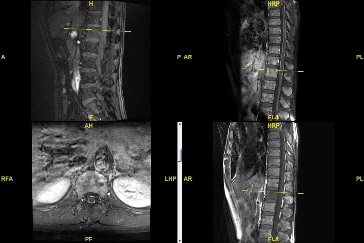 l1椎体活检病例