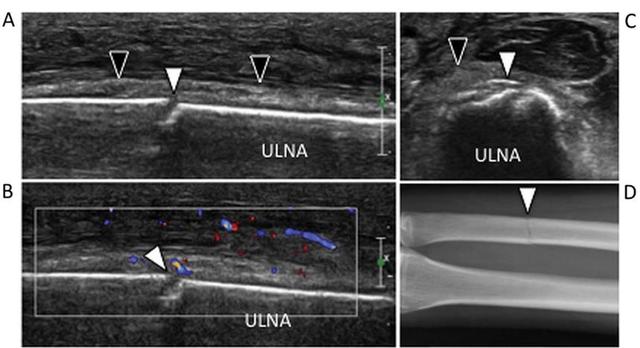 高分辨率超声诊断骨折