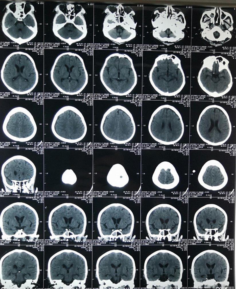 弥漫性轴索损伤昏迷患者还能醒吗 健康号 微医